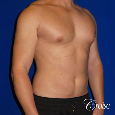 Gynecomastia puffy nipples cost - Before Image 2