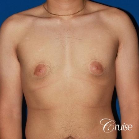 puffy nipple male breast on young adult - Before Image 1