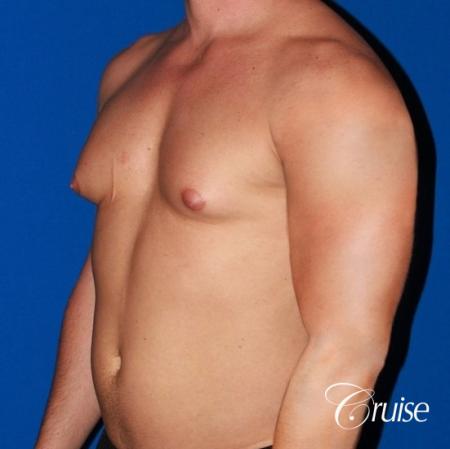 body builder with Gynecomastia puffy nipple - Before Image 3