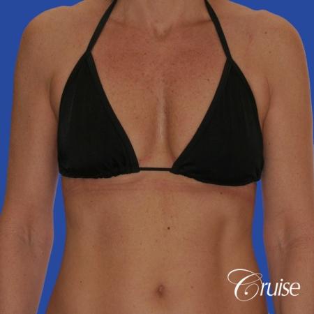 breast lift anchor with silicone implants on adult - Before and After Image 4
