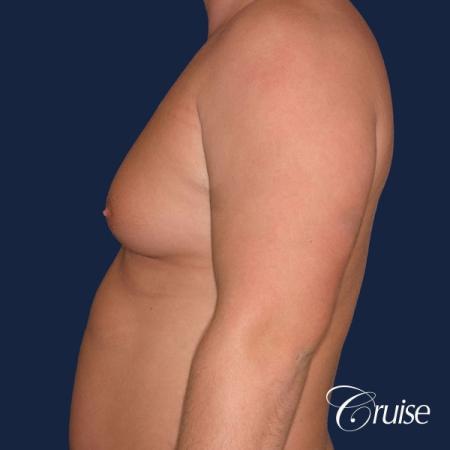 donut lift Gynecomastia correction - After Image 2