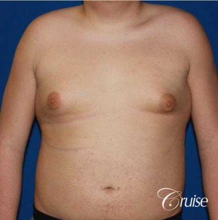 moderate gynecomastia with free nipple graft scar on teenager - Before Image 1
