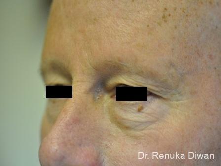 Blepharoplasty For Men: Patient 3 - Before 1