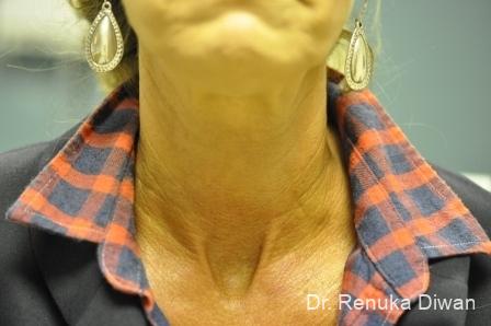 Neck Creases: Patient 2 - After 2