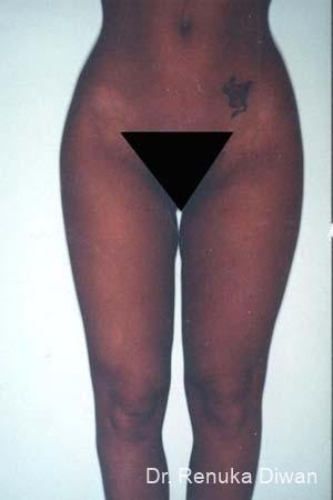 Liposuction: Patient 9 - After  