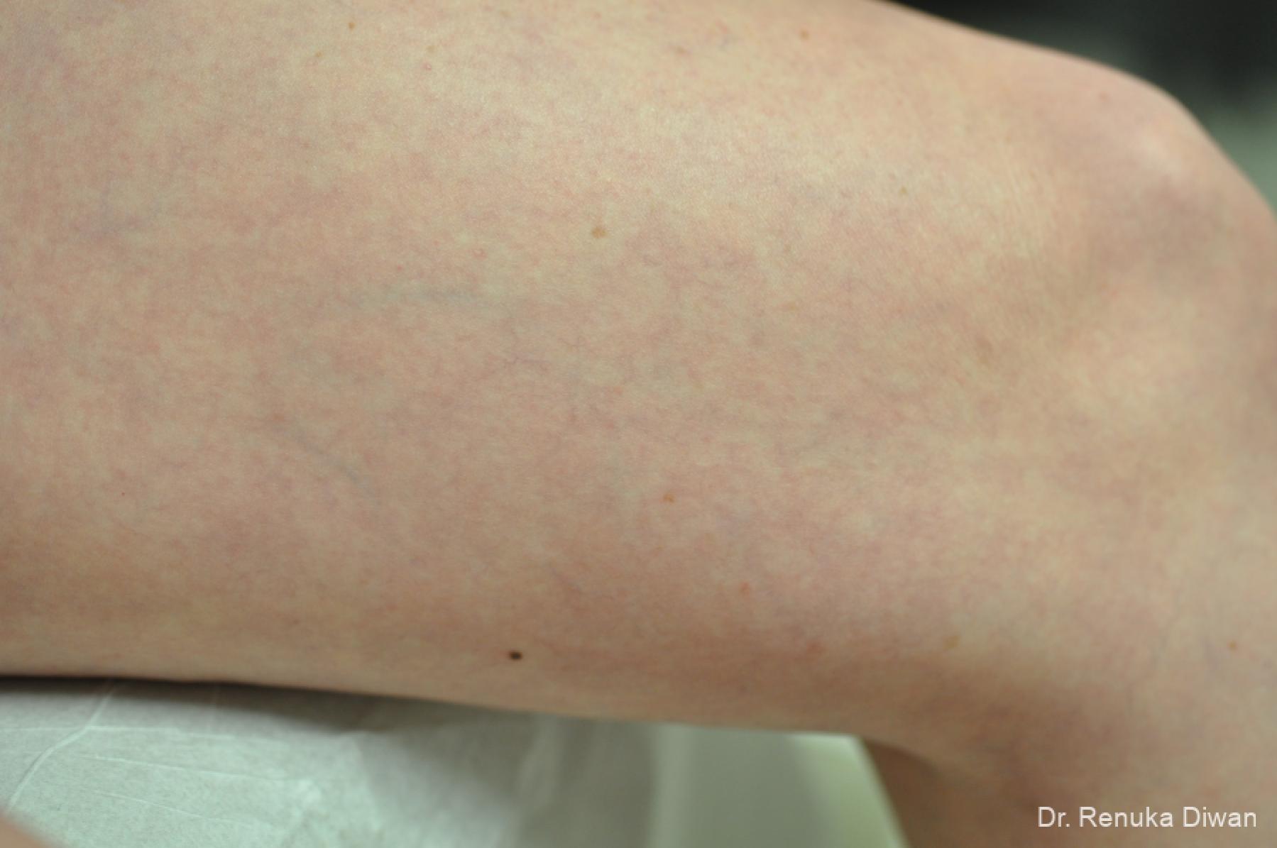 Veins On Legs: Patient 5 - After 3