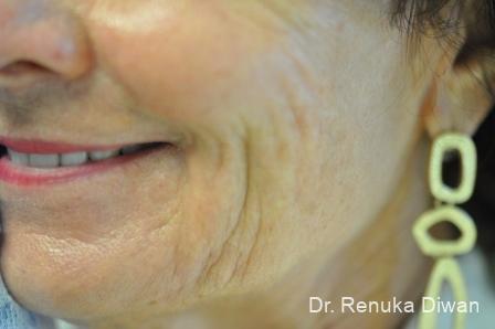 Smile Lines: Patient 8 - Before 