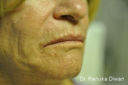 Laser Skin Resurfacing: Patient 9 - Before 1