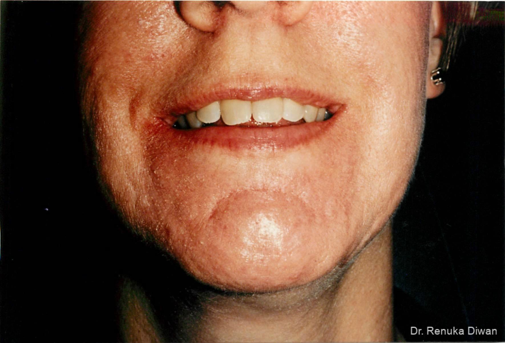 Acne Scars: Patient 2 - After  