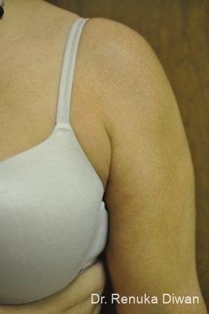Liposuction: Patient 17 - Before 1
