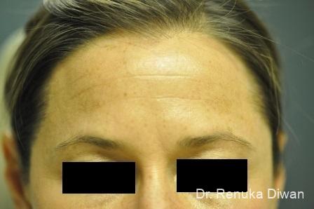 BOTOX® Cosmetic: Patient 14 - Before Image