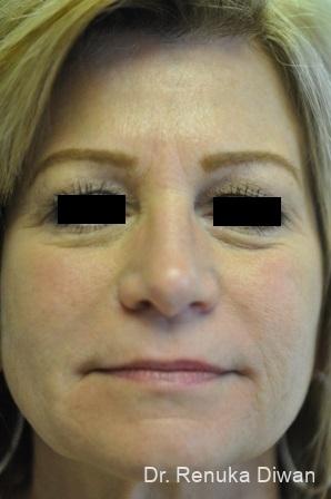 Non-Surgical Facelift: Patient 1 - After  