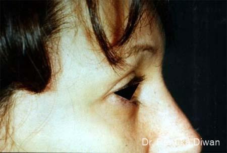 Blepharoplasty: Patient 4 - After  
