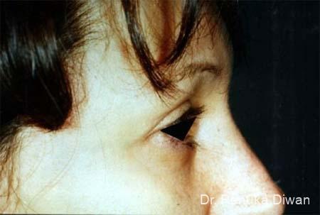 Blepharoplasty: Patient 10 - After 1