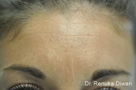 Forehead Creases: Patient 5 - Before 