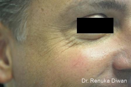 BOTOX® Cosmetic: Patient 25 - Before Image
