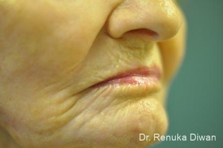 Laser Skin Resurfacing: Patient 10 - After  