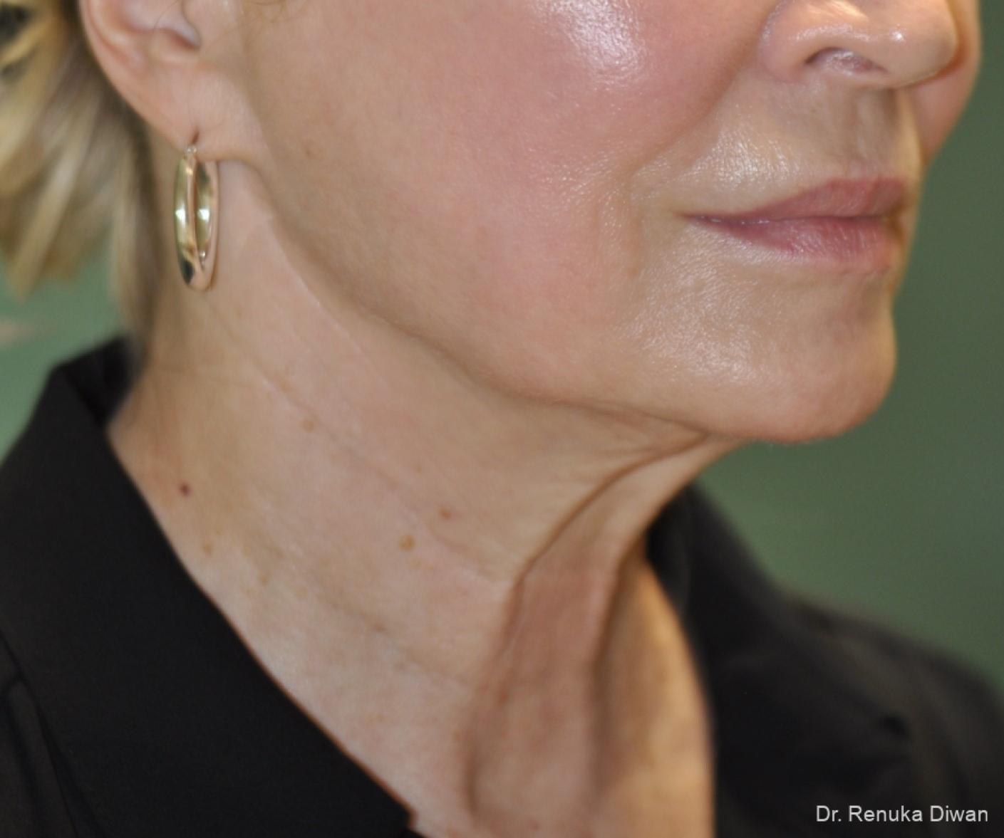 Facelift: Patient 15 - Before and After 3