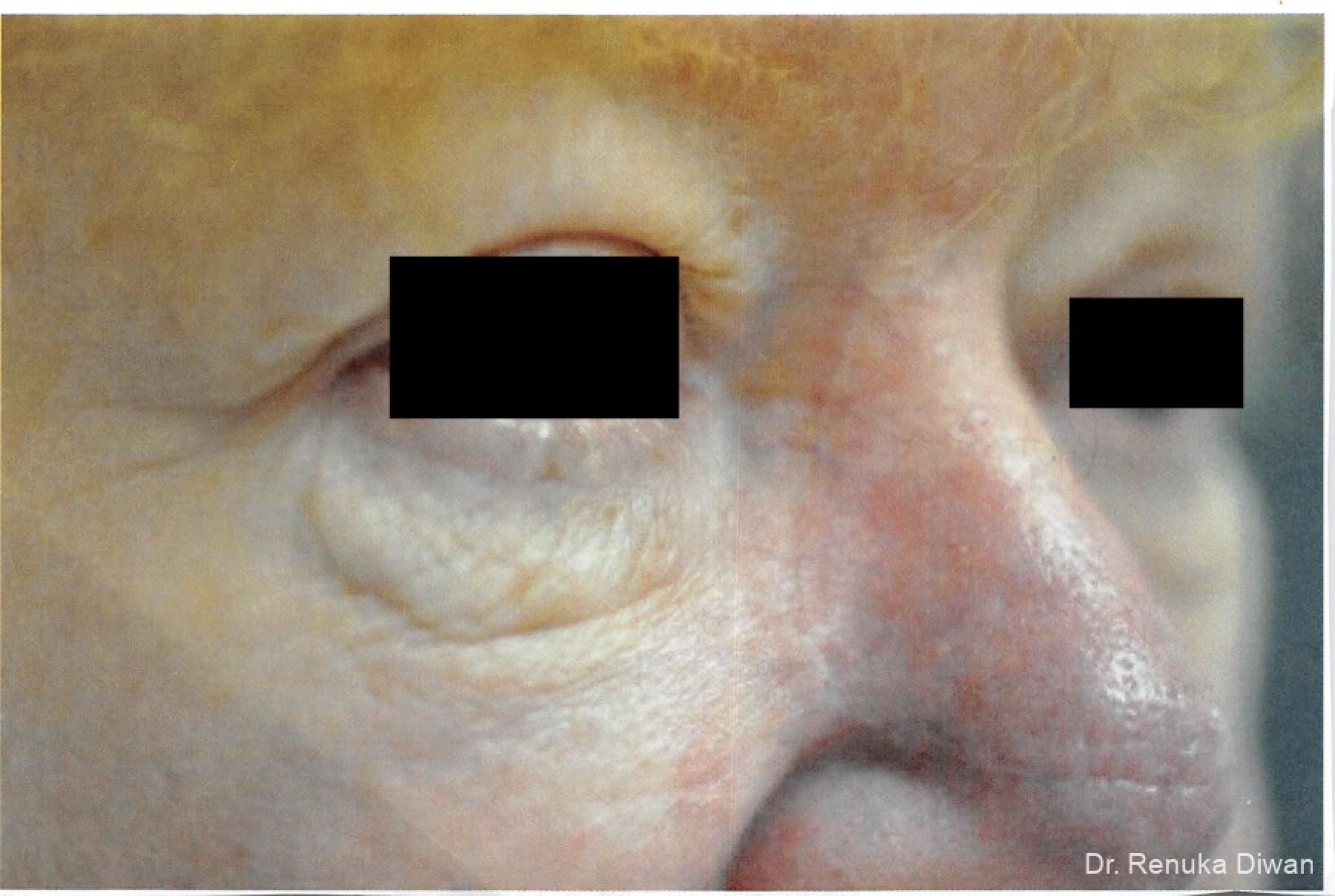 Laser For Veins And Redness: Patient 14 - After 1