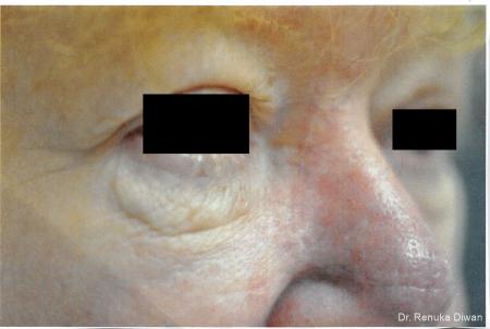 Laser For Veins And Redness: Patient 12 - After 1
