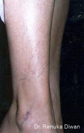 Veins On Legs: Patient 1 - Before 1
