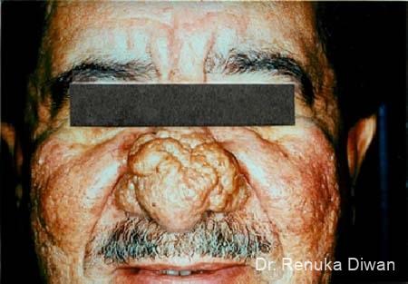 Lasers For Rhinophyma: Patient 1 - Before 1