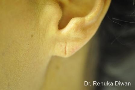Earlobe Surgery: Patient 2 - Before 