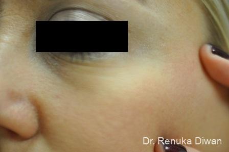 Laser For Veins And Redness: Patient 10 - After 2
