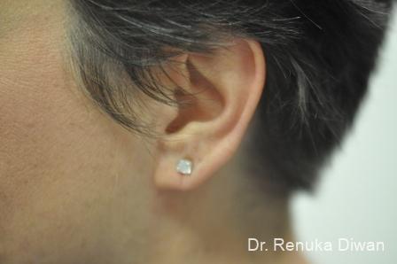 Earlobe Surgery: Patient 1 - After  