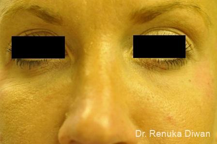 BOTOX® Cosmetic: Patient 2 - Before 