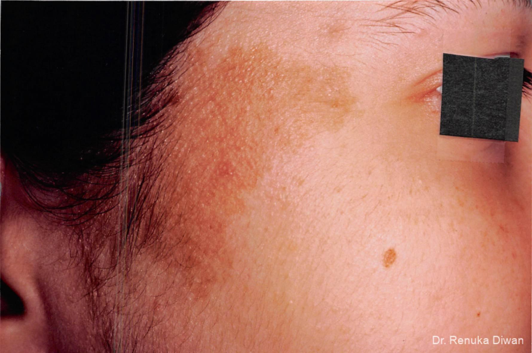 Lasers For Brown Spots: Patient 1 - Before 