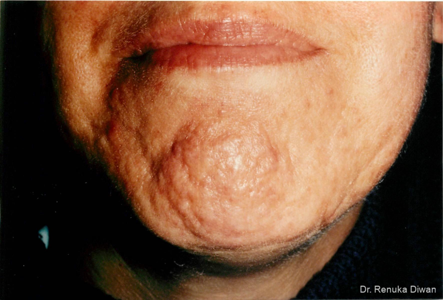 Acne Scars: Patient 2 - Before 