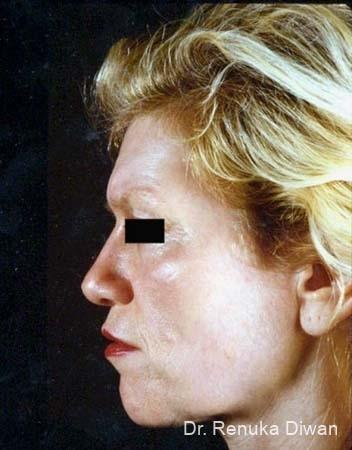 Chemical Peel: Patient 1 - After 1