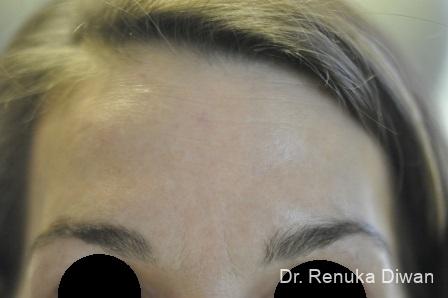 BOTOX® Cosmetic: Patient 15 - After 1