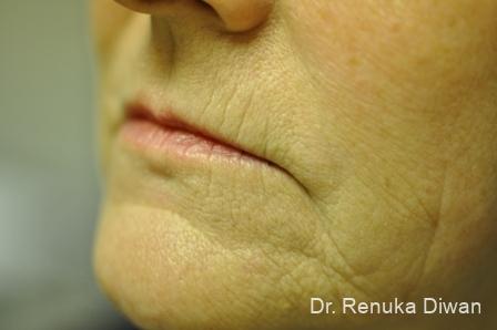 Laser Skin Resurfacing: Patient 2 - Before 1