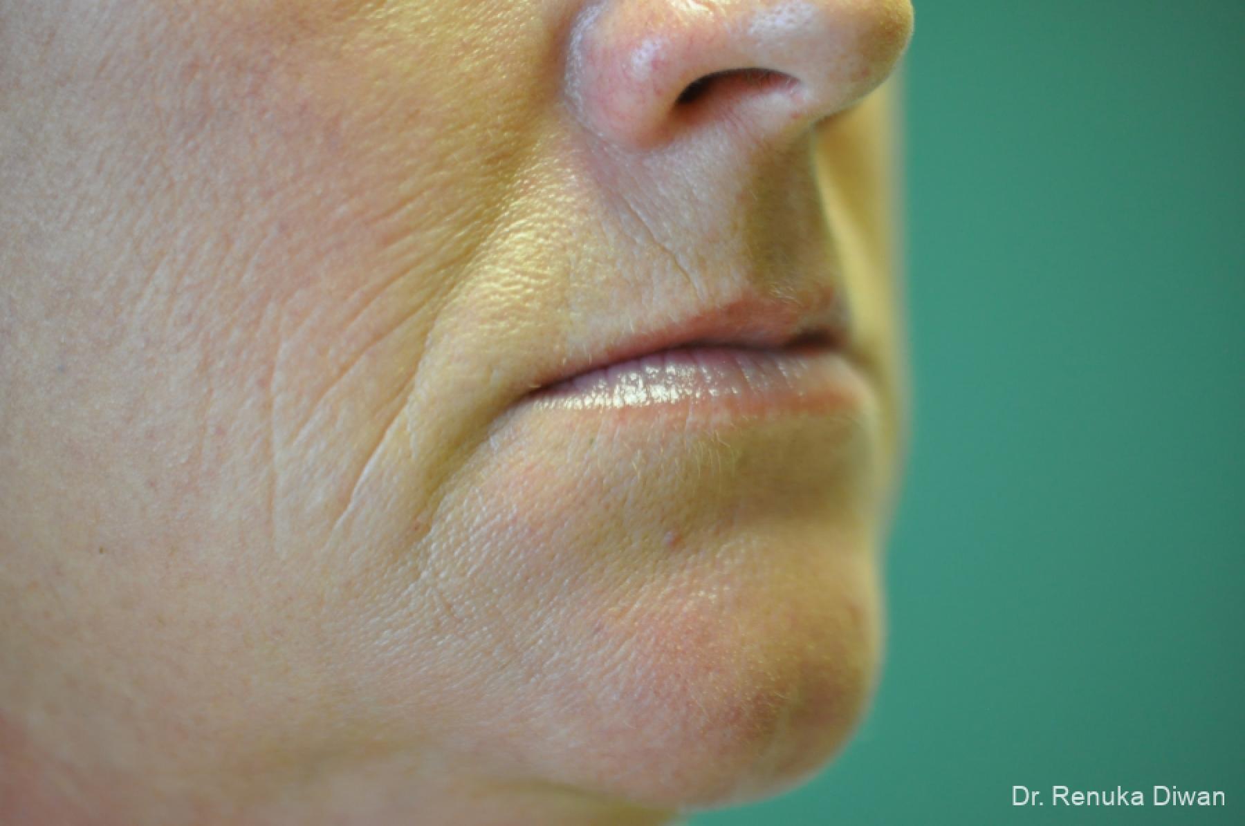 Microneedling: Patient 4 - Before 