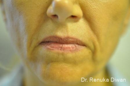 Marionette Lines: Patient 3 - Before 