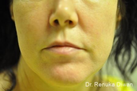 Laser For Veins And Redness: Patient 7 - After 1