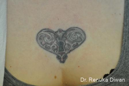 Tattoo Removal: Patient 8 - Before 1