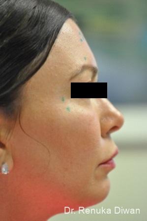 Chin Augmentation: Patient 4 - Before 