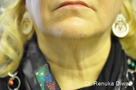 Kybella: Patient 3 - After 1