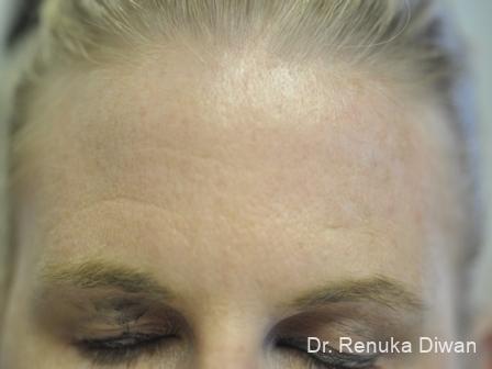 BOTOX® Cosmetic: Patient 3 - Before 