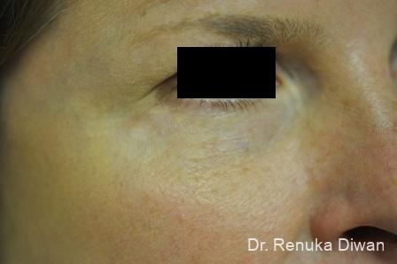 Laser For Veins And Redness: Patient 14 - After 1