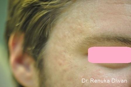 Acne Scars: Patient 4 - After  