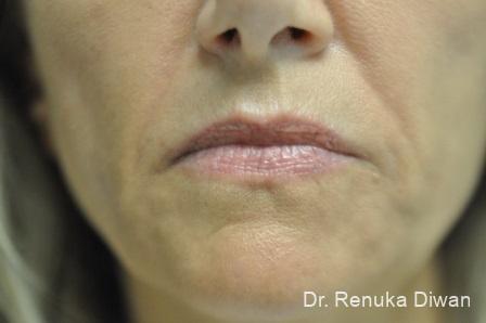 Marionette Lines: Patient 3 - After  