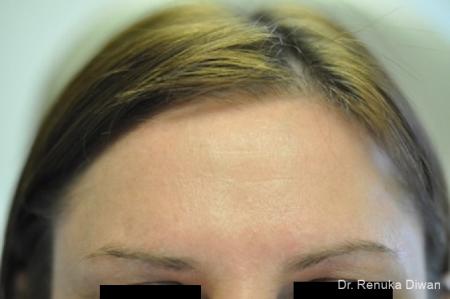 BOTOX® Cosmetic: Patient 17 - After Image