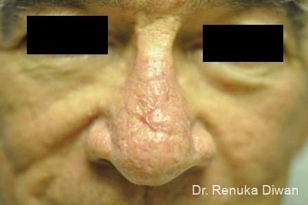 Laser-skin-resurfacing-for-men: Patient 2 - Before 