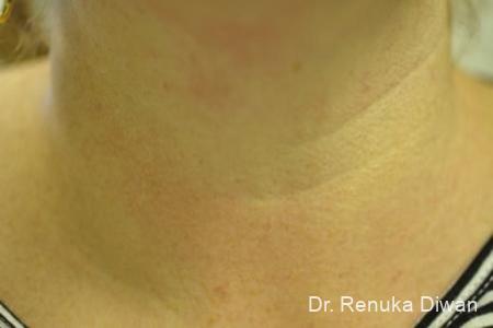 Neck Creases: Patient 1 - Before 1