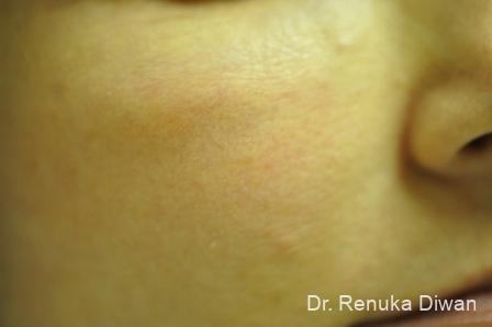 Laser For Veins And Redness: Patient 4 - After 1