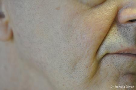 Laser-skin-resurfacing-for-men: Patient 3 - After  